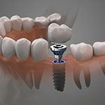 Dental implant, abutment, and crown between natural teeth