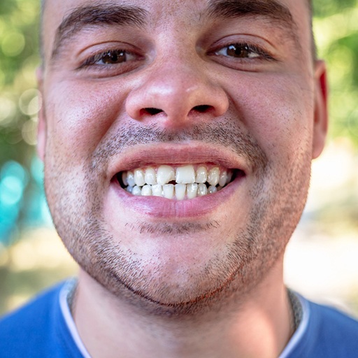 Man with a chipped front tooth