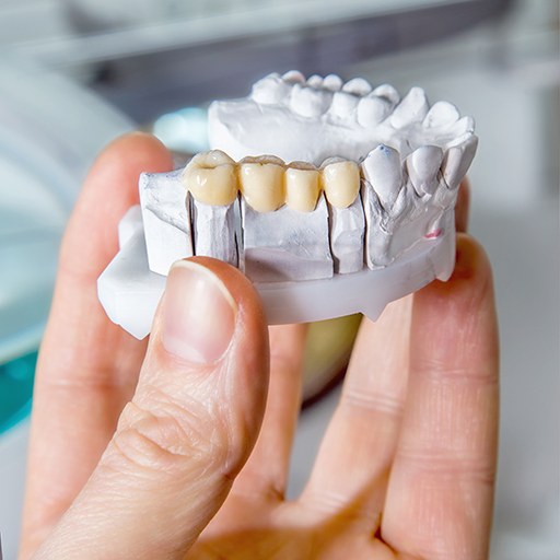 Hand holding model lower arch with a dental bridge over the back 4 teeth