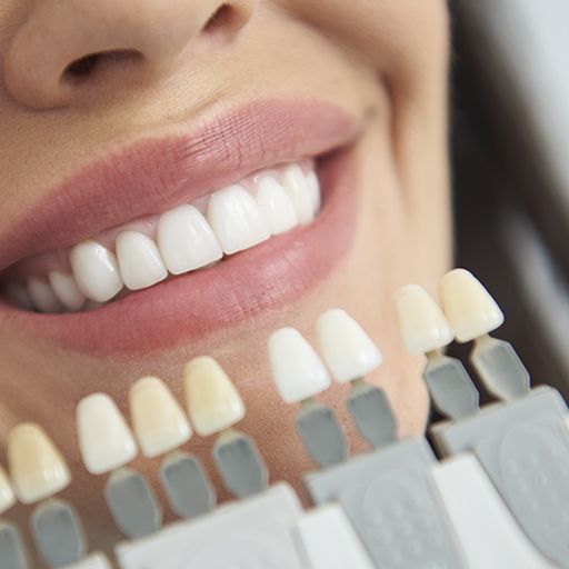 Woman's smile compared to porcelain veneer shade chart