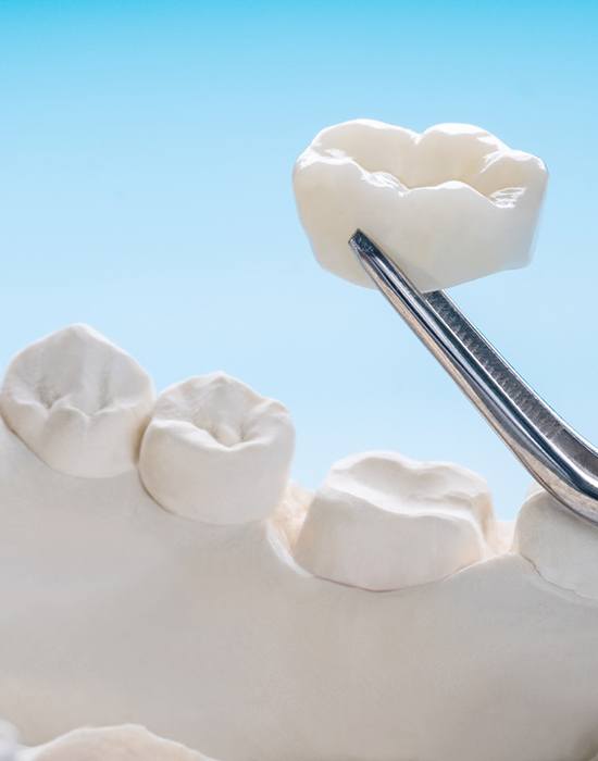 a model of a dental crown