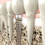 Digital illustration of a dental implant