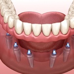 Digital illustration of implant dentures in Fort Worth