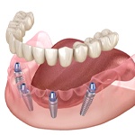 Digital illustration of an implant denture in Fort Worth