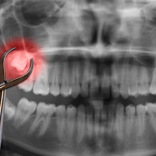 Forceps over x-ray with impacted tooth highlighted red