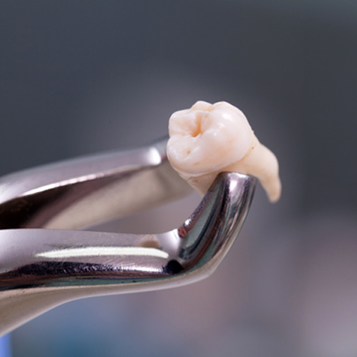 Closeup of extracted tooth held by forceps