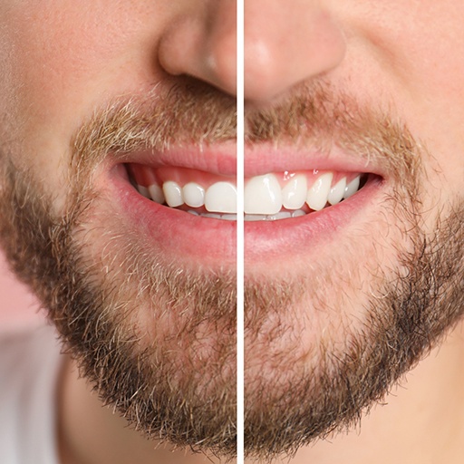 Before and after gum recontouring