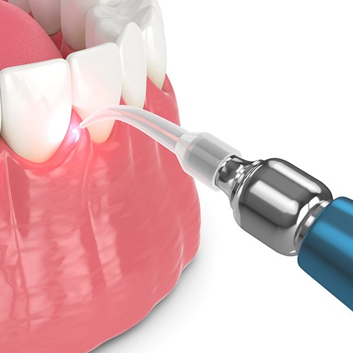 Illustration of gum recontouring