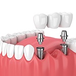 implant bridge illustration for cost of dental implants in Fort Worth 