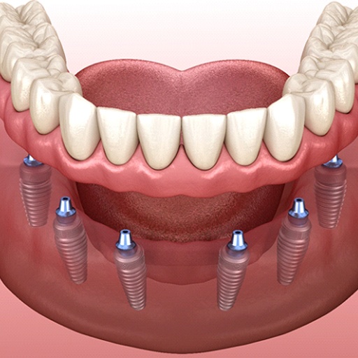 Model of implant dentures in Fort Worth, TX being attached to six implants