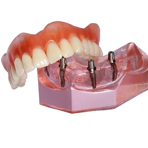 Model of dentures and dental implants in Fort Worth, TX