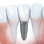 Animated smile with dental implant supported dental crown