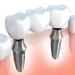 Animated smile with dental implant supported fixed bridge