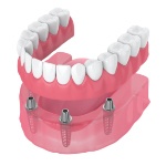 Animated smile with dental implant supported denture