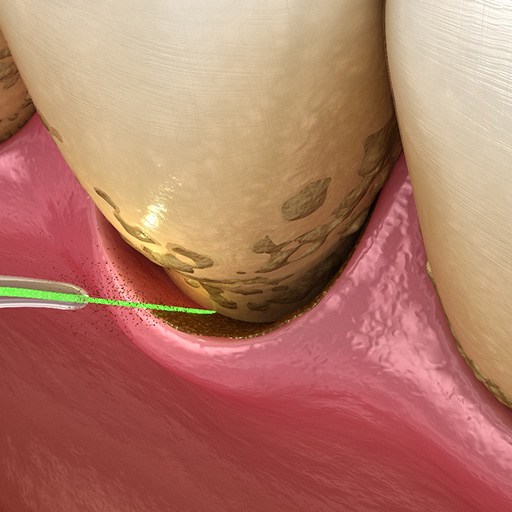 Laser periodontal treatment