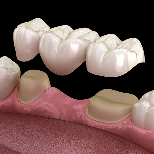 Animated smile during dental bridge restoration