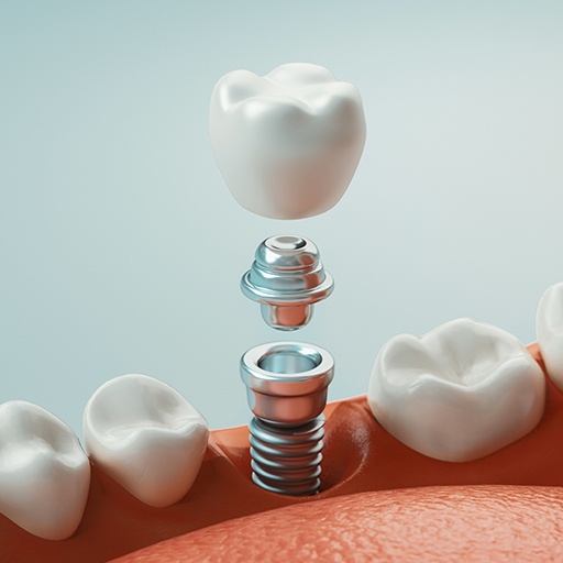 Animated parts of a dental implant replacement tooth