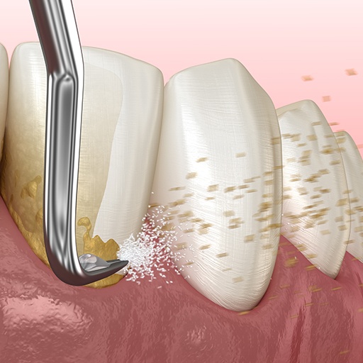 Animated smile during scaling and root planing treatment