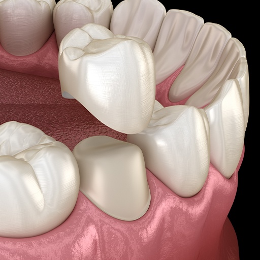 Animated smile during dental crown placement