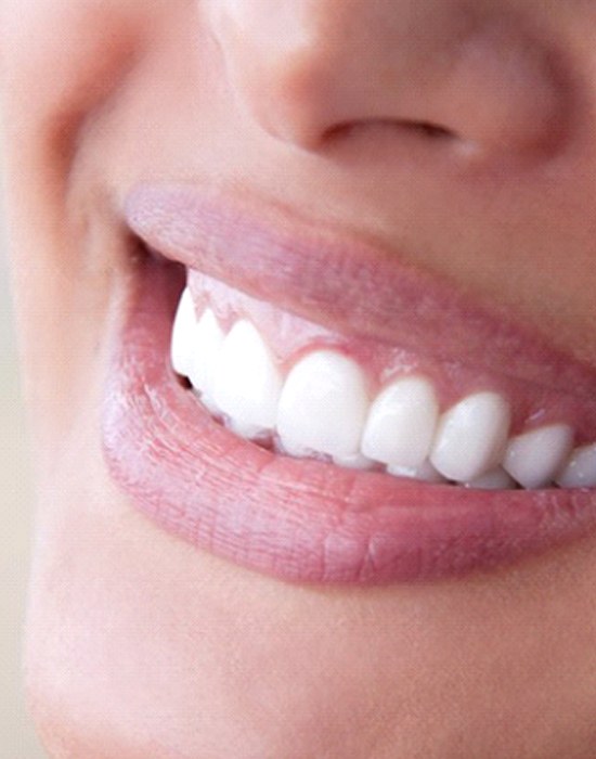 Closeup of beautiful smile with veneers in Fort Worth