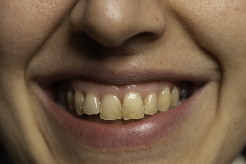 Woman smiling with discolored teeth