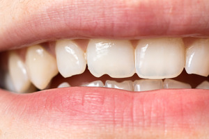 Close-up of a tooth that has been chipped