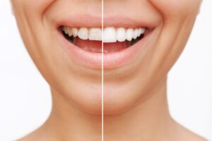Closeup of someone smiling with one half of their mouth treated with whitening or veneers and the other half naturally imperfect
