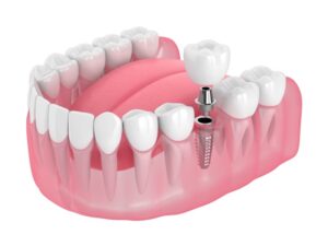 Animated model of dental implant. 
