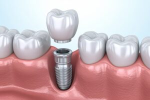 Animated model of dental implant.